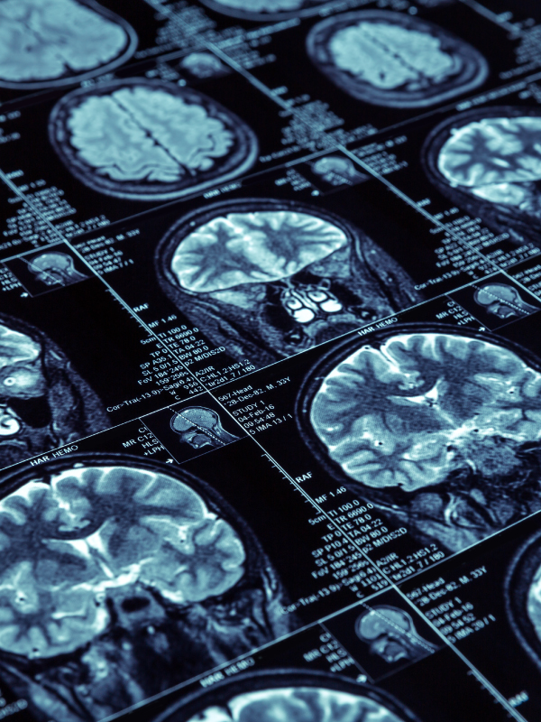 Chronic Traumatic Encephalopathy: The Preventable Silent Killer