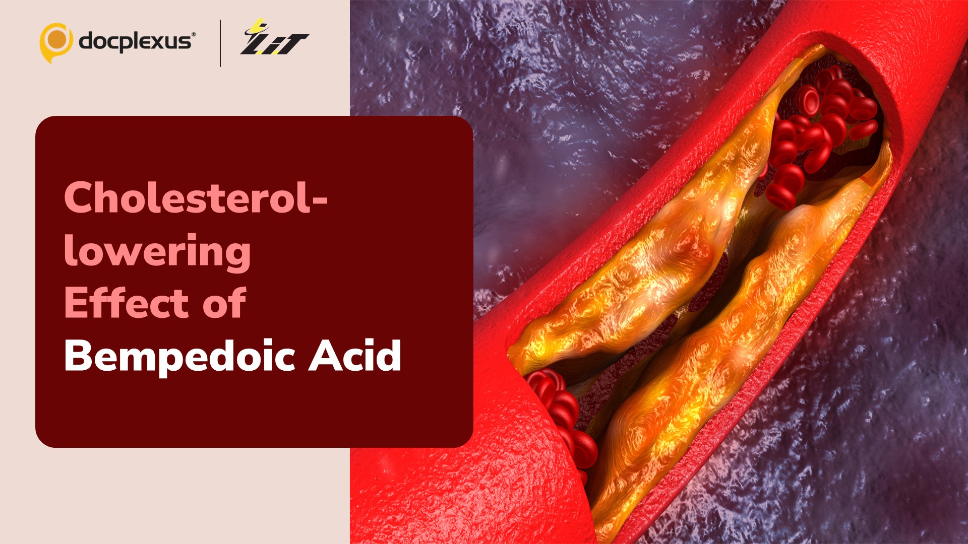 Bempedoic Acid: A New Hope for Statin-intolerant Individuals