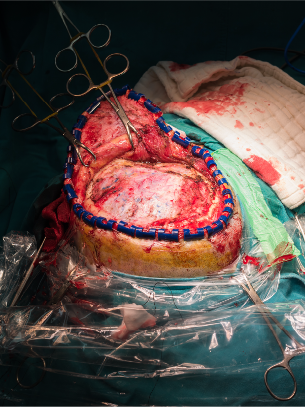 Insights on Awake Craniotomy and Spine Surgery