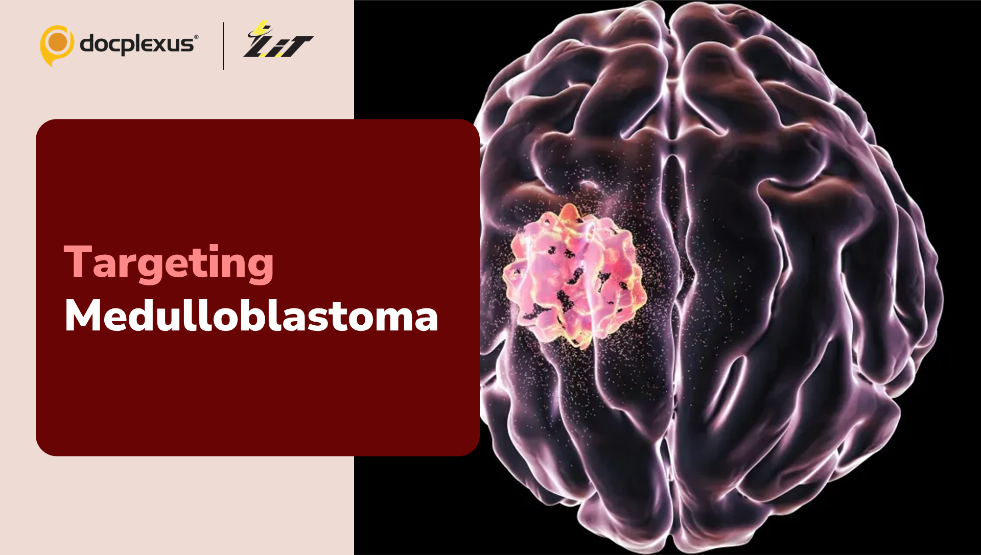 A Promising New Therapy for Medulloblastoma
