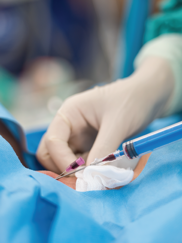 Do We Still Need Endophlebectomy for Deep Venous Stenting?