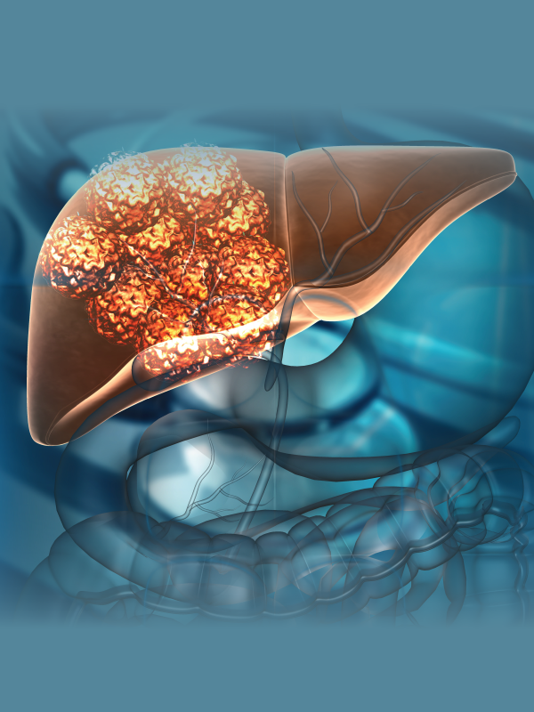 The Evolving Role of TKIs in First-line Treatment of Advanced HCC
