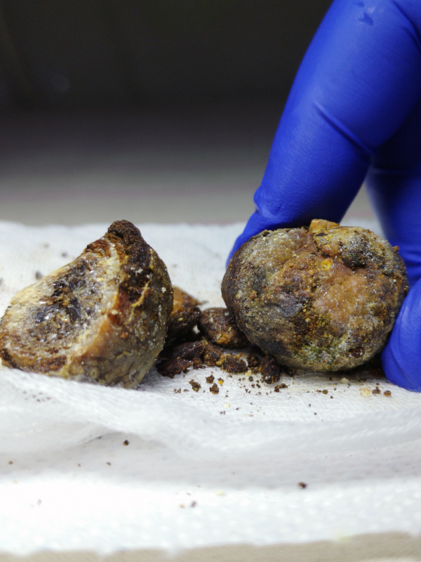 Laparoscopic Approach – When the Gallstones Get Tough