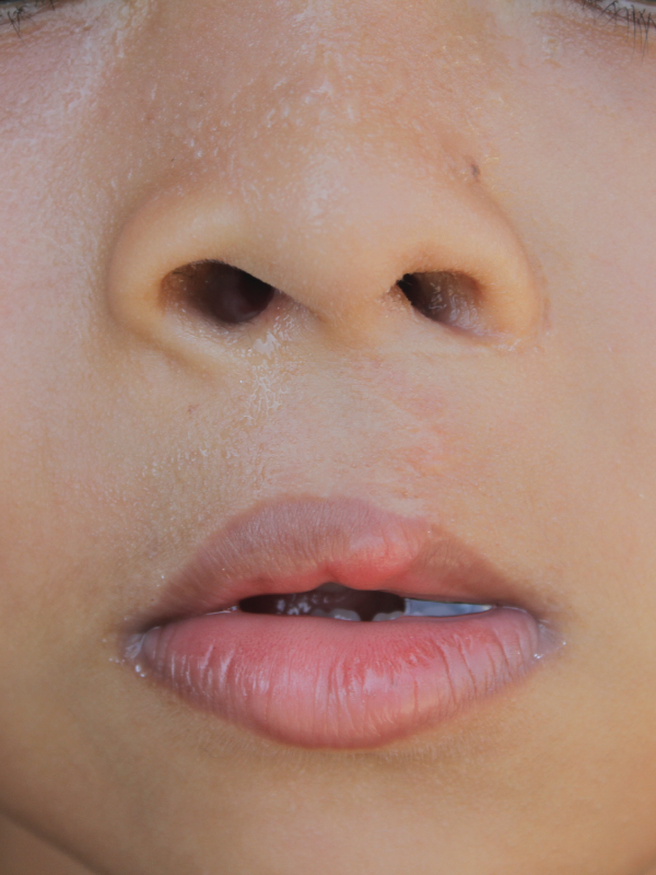Cleft – Nutrition and Care After Birth