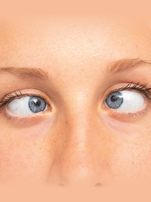 Strabismus: Evaluation and Management