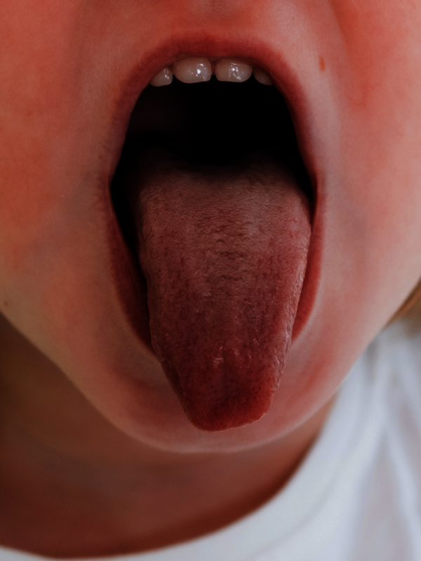 Tongue Reconstruction