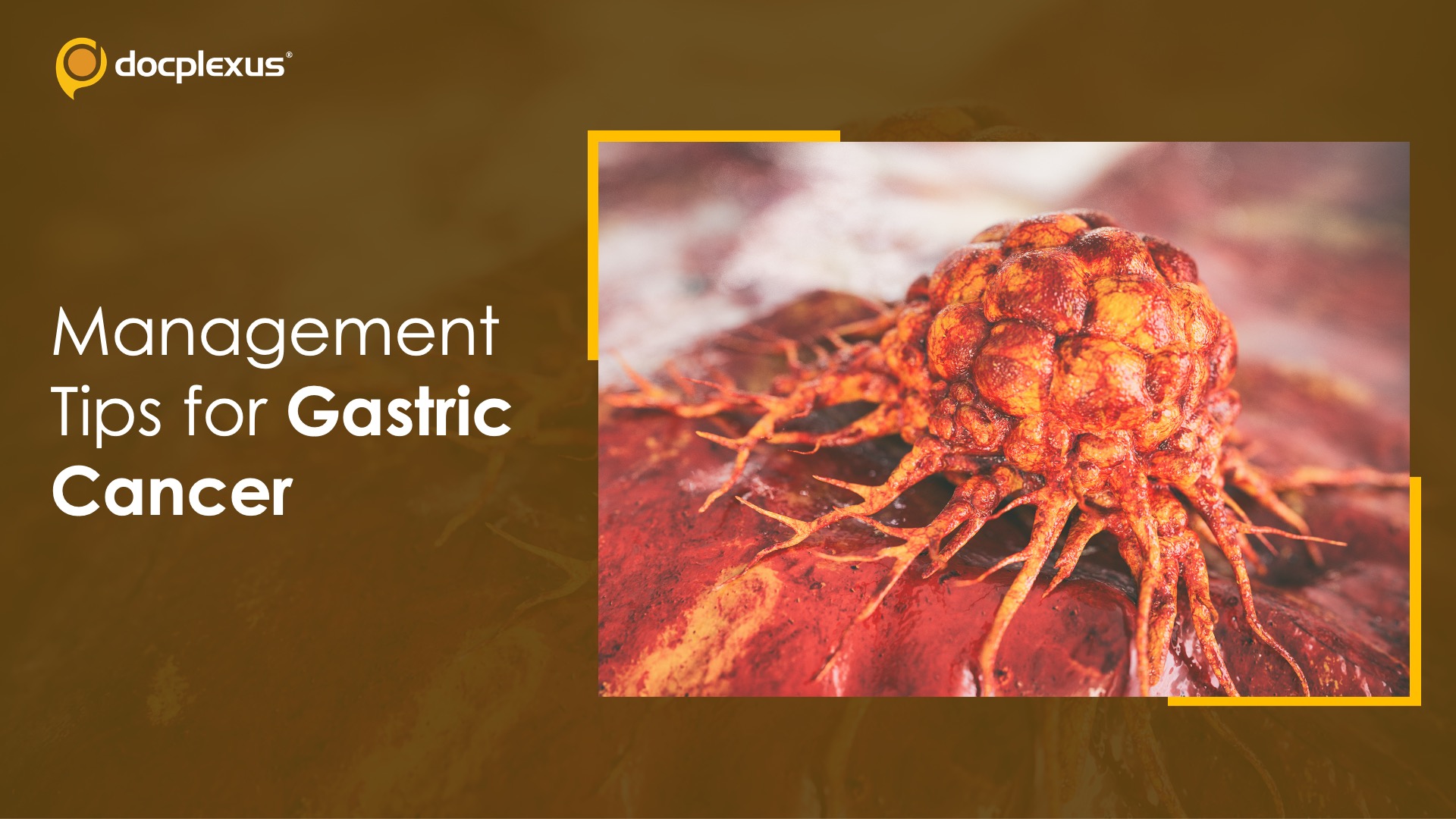 Management Tips for Gastric Cancer