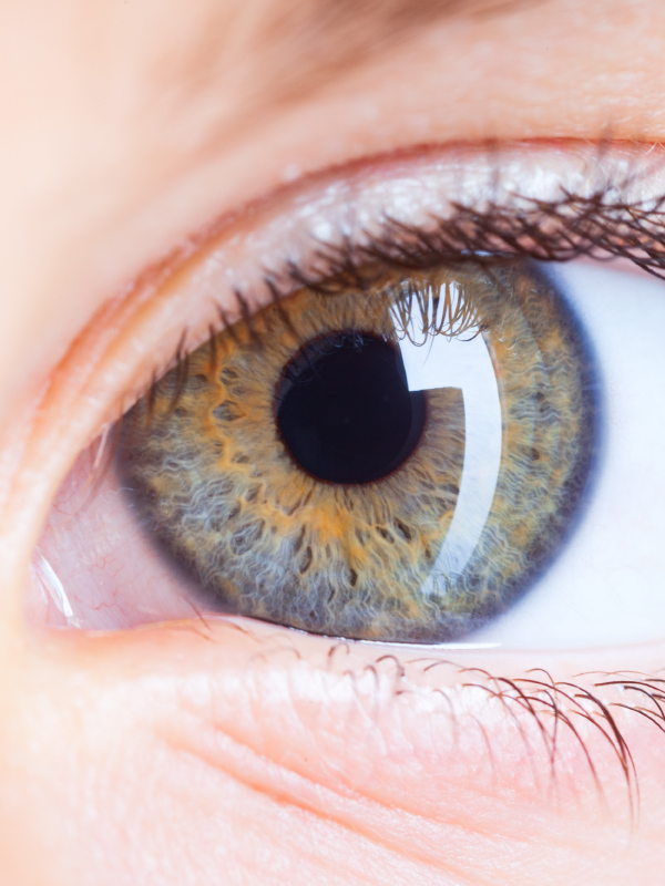 Herpes Simplex Virus Keratitis