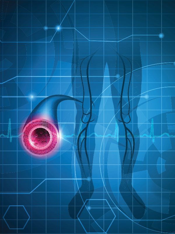 Hybrid Interventions in critical limb ischemia