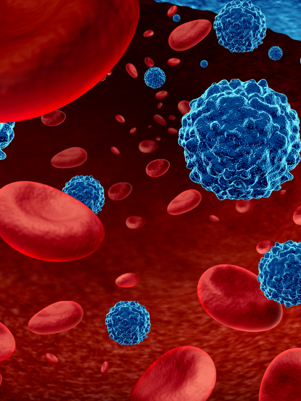 Multiple Myeloma