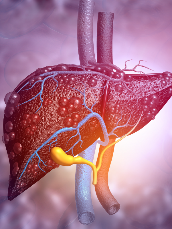 NAFLD Management and Lessons Learnt So Far