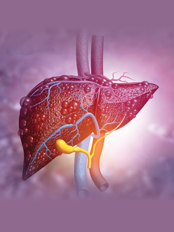 Management of NASH/NAFLD | Liquid Biopsy of Kidney