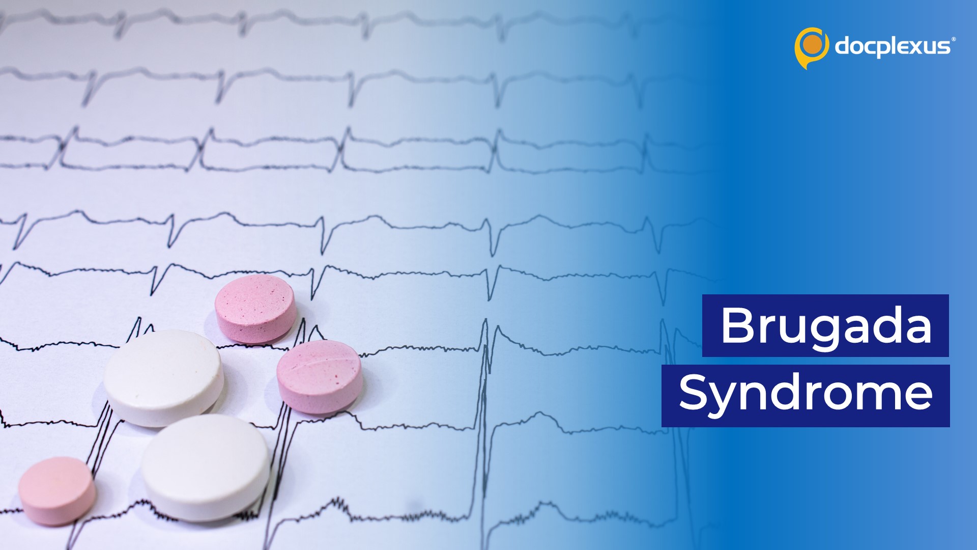 Brugada Syndrome – A Rare Inherited Channelopathy