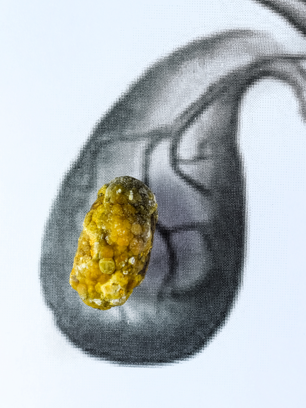 Laparoscopic Cholecystectomy: Steps for Success
