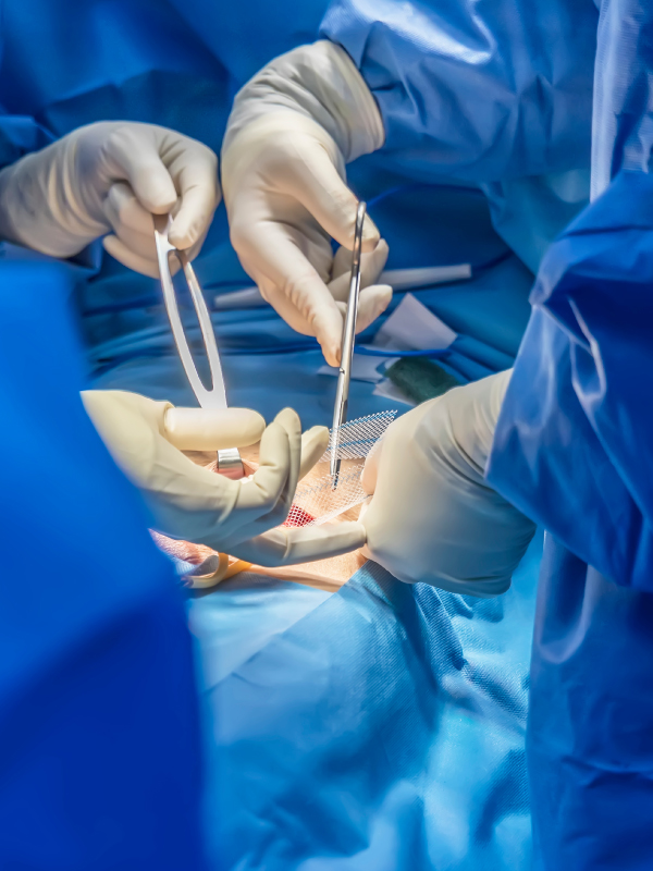 Peritoneal Flap Technique for Large Complex Ventral Hernias