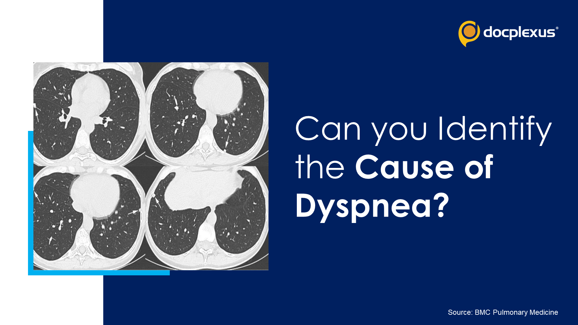 Dry Cough and Dyspnea: What’s Your Diagnosis?
