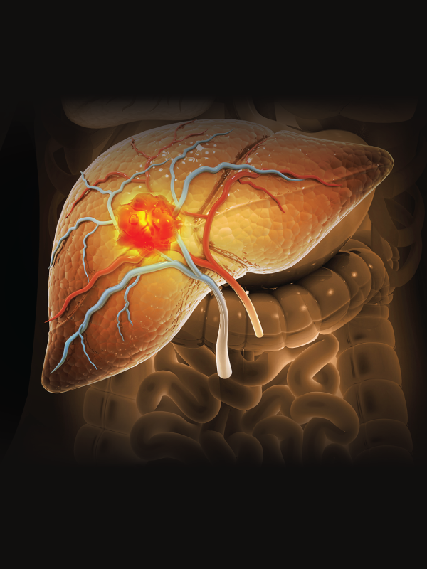 Jaundice and Liver Tumors: Symptoms, Types, Diagnosis, and Management Strategies