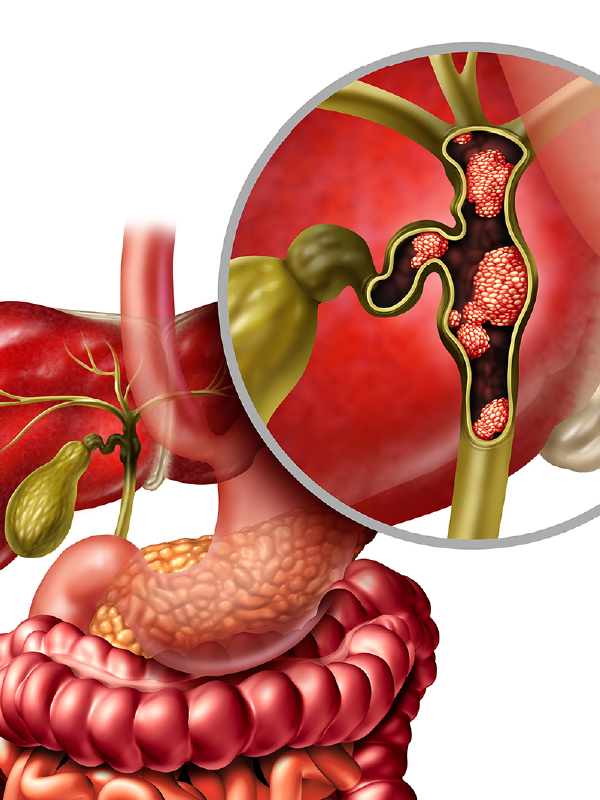 Let's Discuss Cholangiocarcinoma!