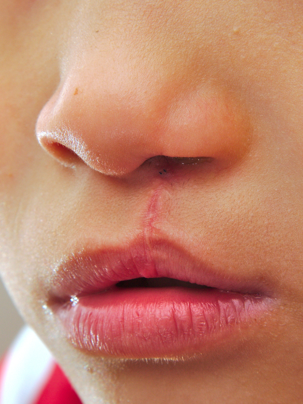 Unilateral Cleft Lip Repair – Assessment, Planning, and Techniques