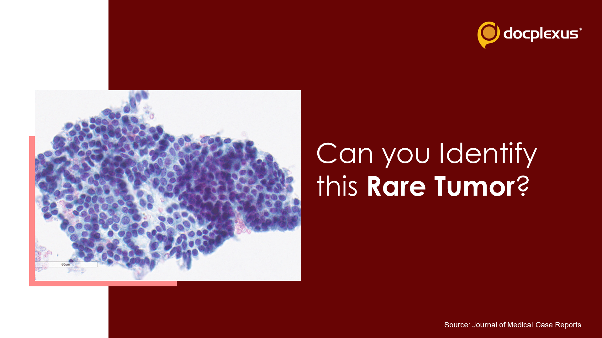 A Woman with Painless Lump in Her Throat: What's Your Diagnosis?