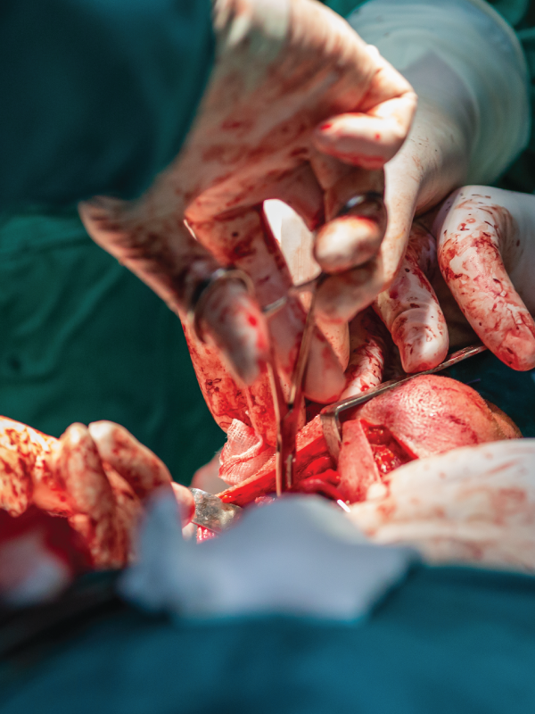 Resection of Carotid Body Tumor