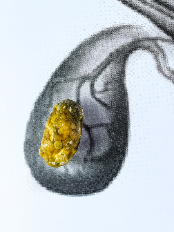 Laparoscopic Cholecystectomy: Steps for Success