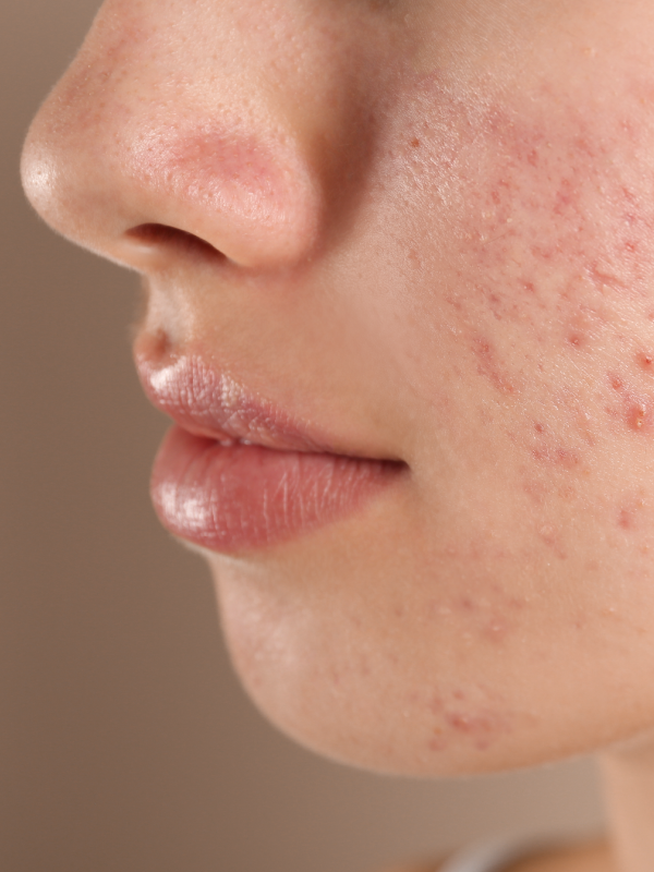 Bacteriology of Acne and Biofilms | Emerging Treatments for Psoriasis