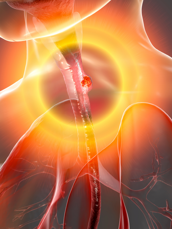 Lymphadenectomy in Middle Third Esophagus Carcinoma