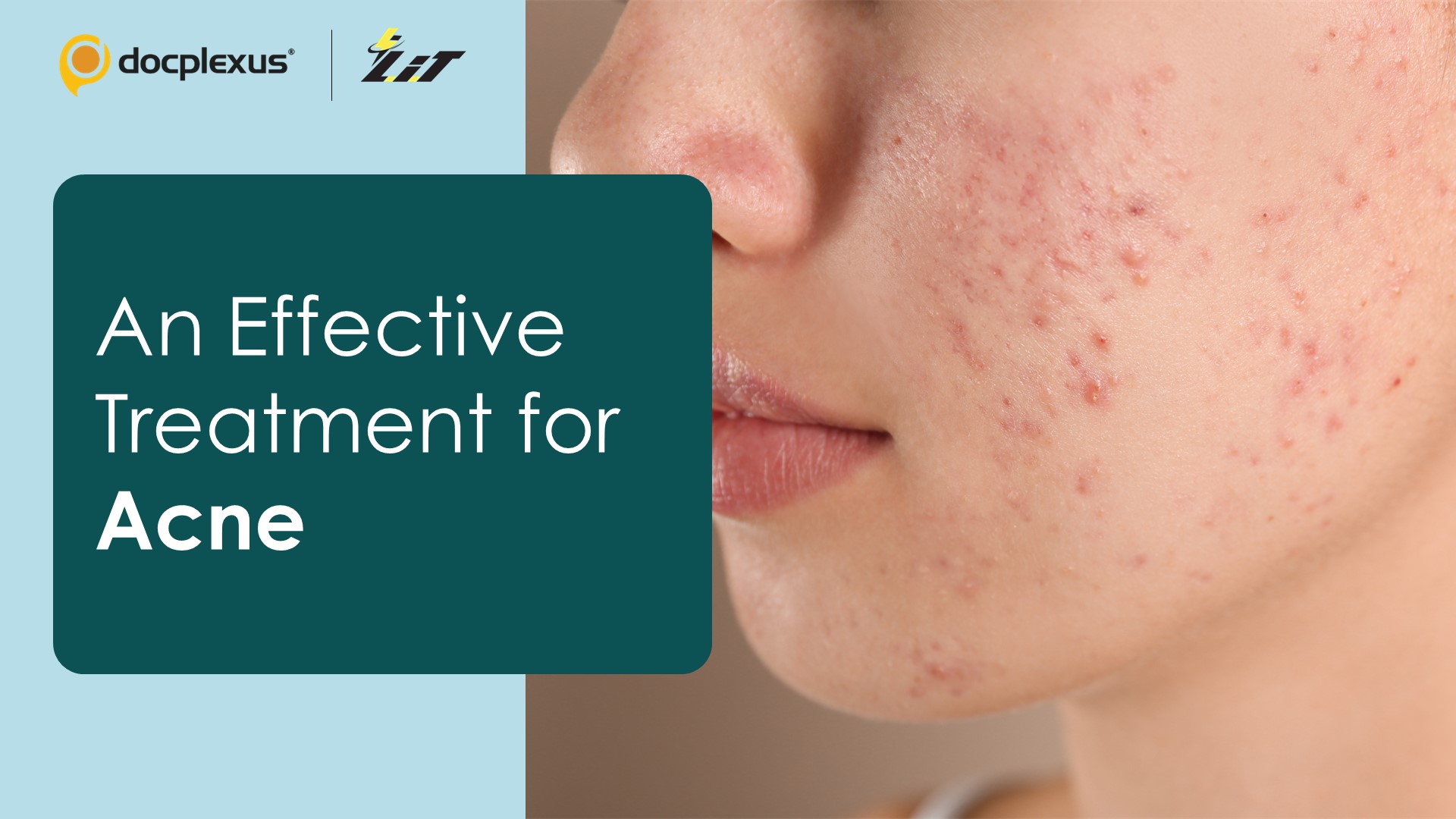 Non-antibiotic Treatment for Acne – Is It Possible?