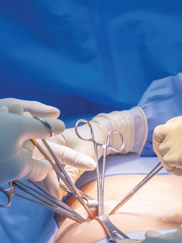 Principles of Surgery for GERD (Lap Hiatus Hernia Repair & Fundoplication)
