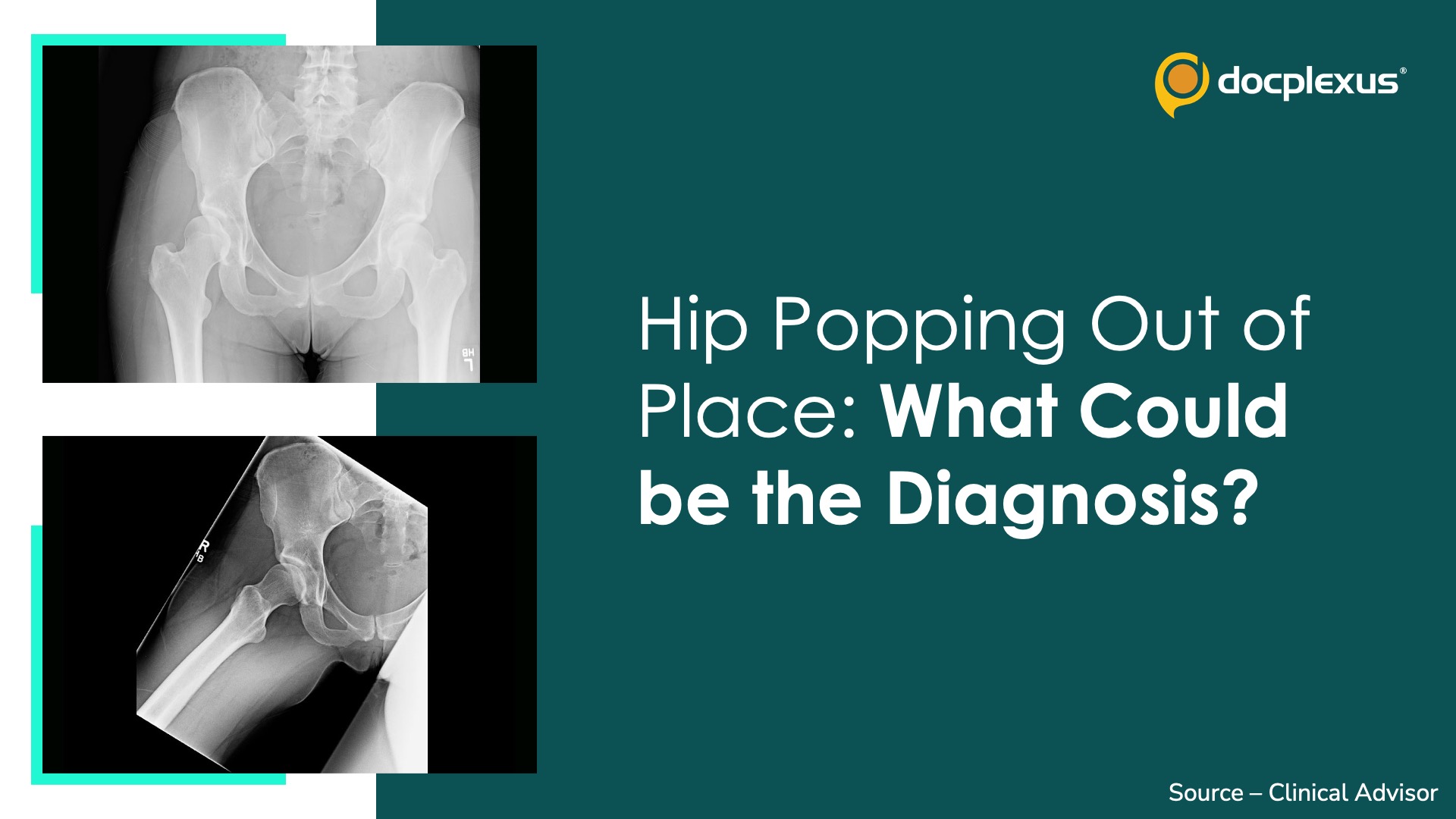 Hip Popping out of Place: What Could be the Diagnosis?