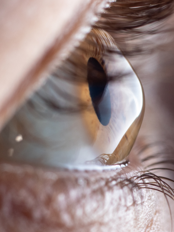 Keratoconus: Preferred Practice Patterns
