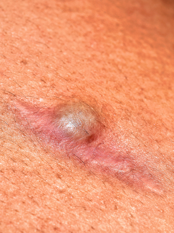 Pilonidal Sinus