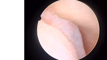 TMJ Arthroscopy level 2 - A Case of IntraJoint Villo-Nodular Synovitis 