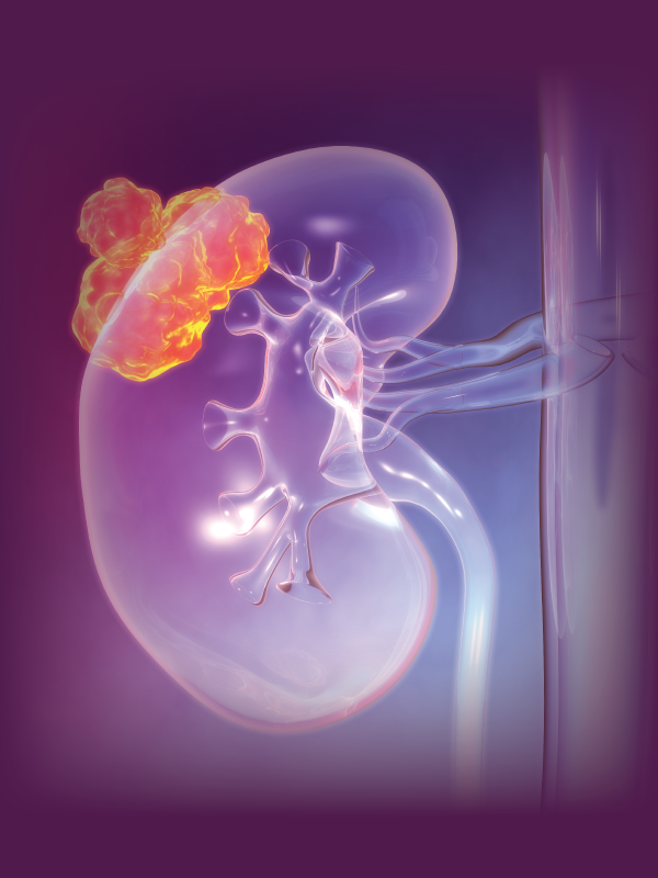 Nephron Sparing Surgery in Kidney Cancer