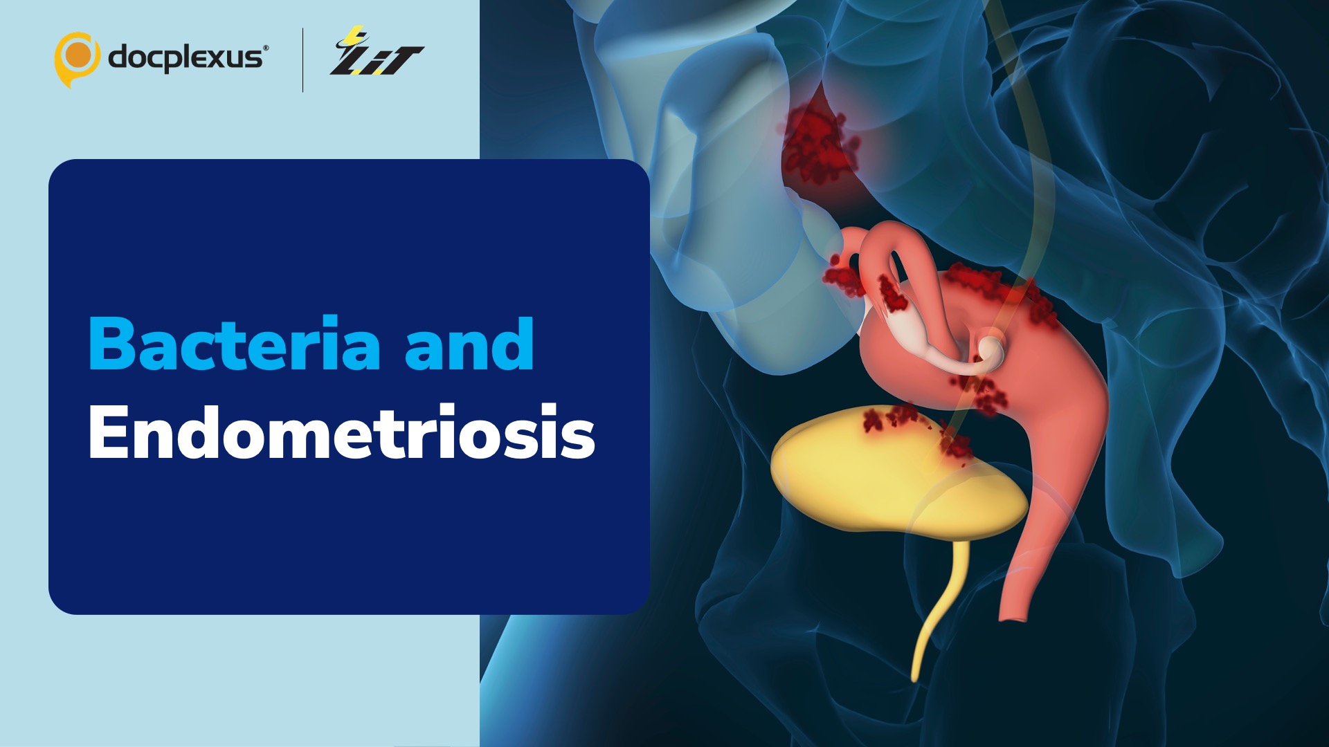 Can Bacteria Play a Role in the Development of Endometriosis?