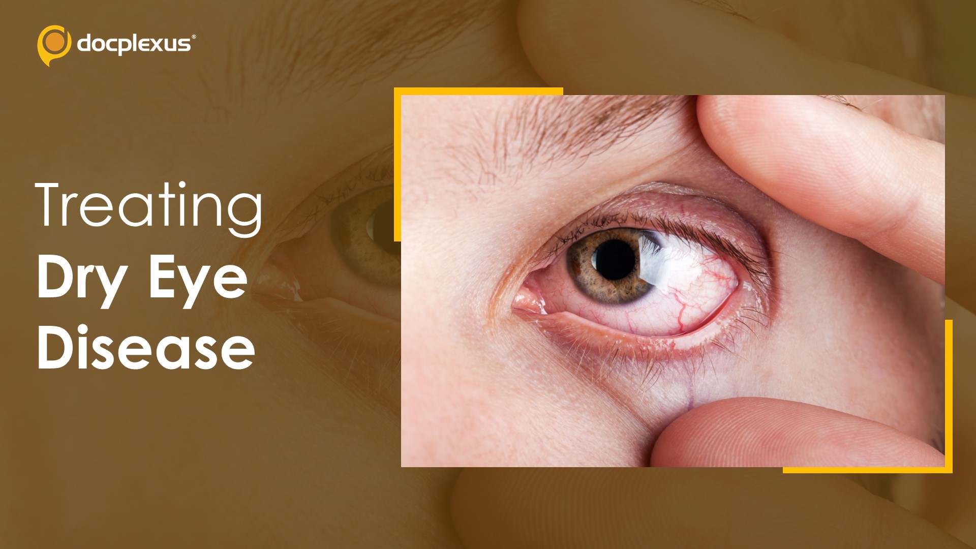 USFDA Approves Perfluorohexyloctane for Treating Dry Eye Disease