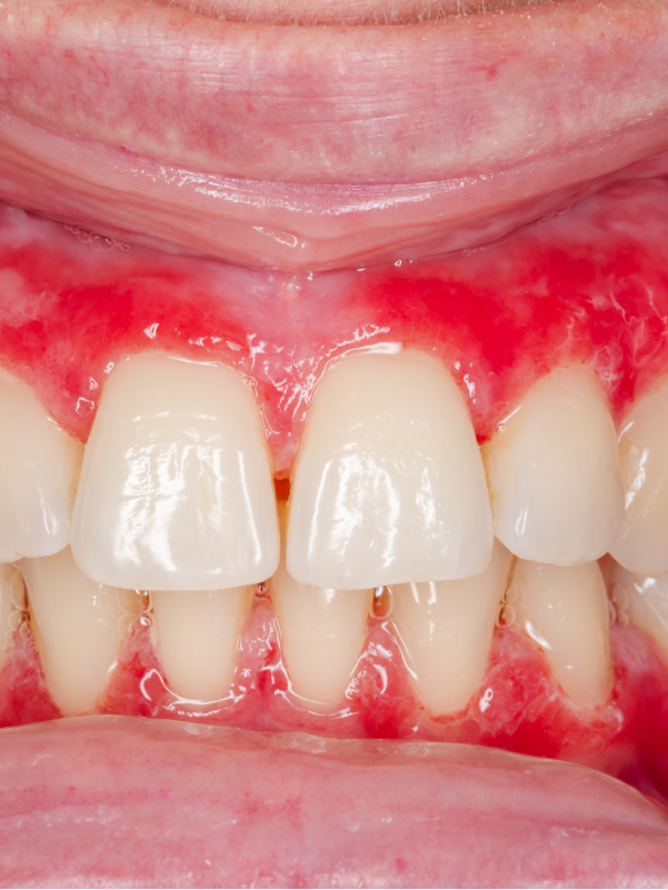 Sjögren's Syndrome – Oral Manifestations and Management