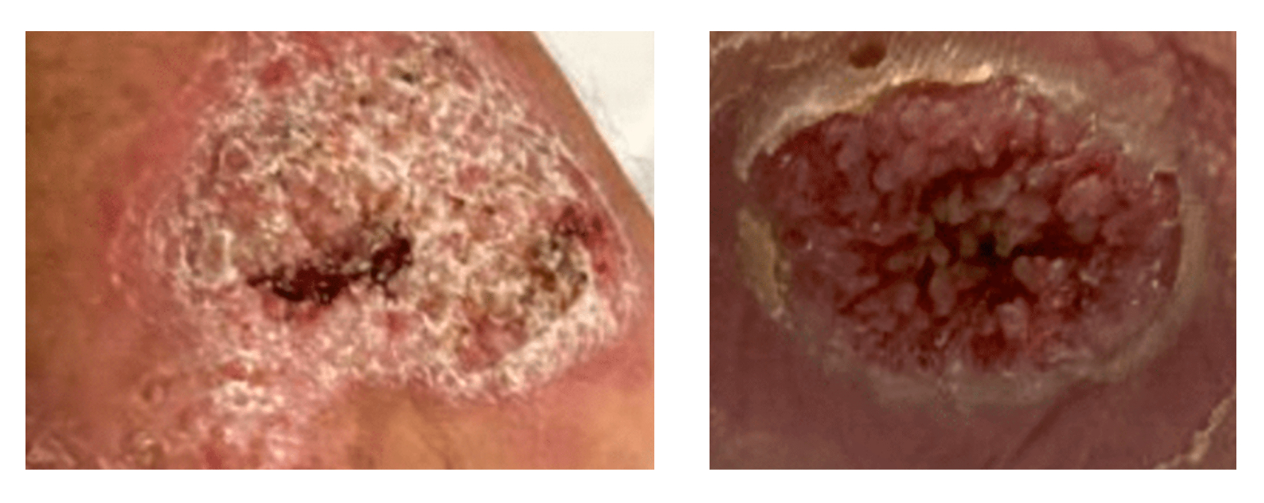 Suggest duration of itraconazole treatment