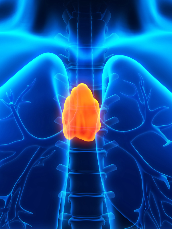 3D VATS Extended Thymectomy for Thymoma in Myasthenia Gravis Patients