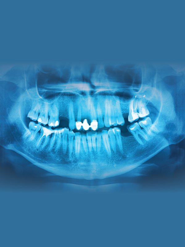 Use of Free Fibula Flap for Mandibular Reconstruction