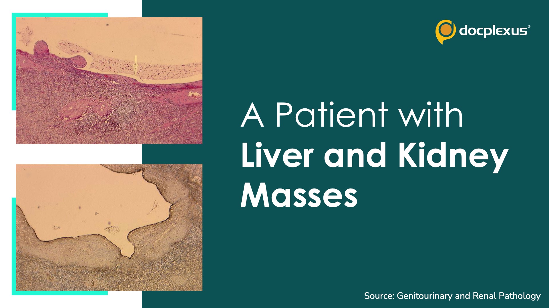 A Patient with Liver and Kidney Masses