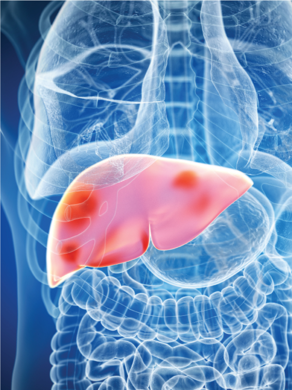 LI-RADS Criteria for Liver Nodules, Liver Tumor, and Liver Cirrhosis
