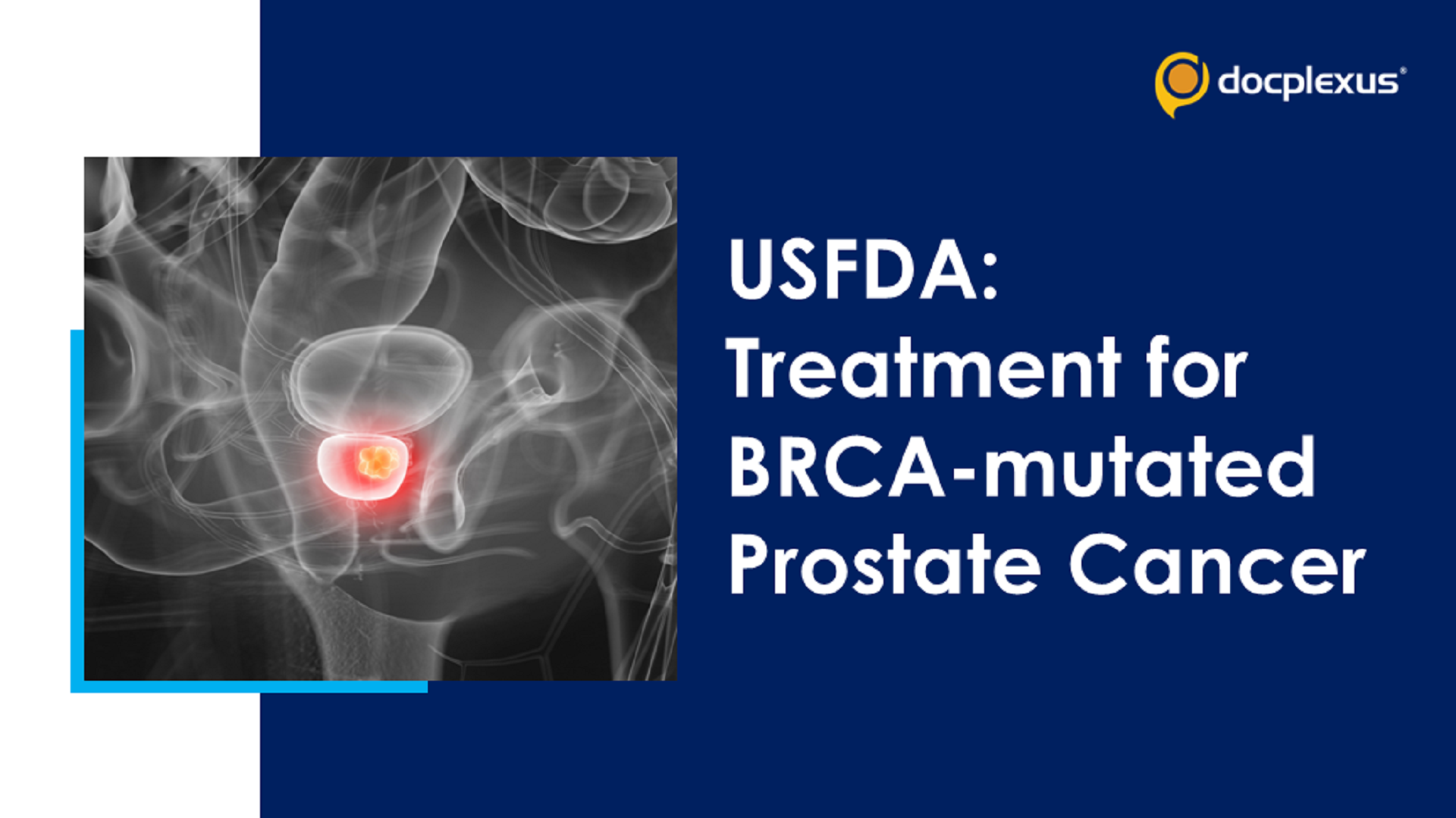 USFDA Approves New Treatment for BRCA-mutated Prostate Cancer