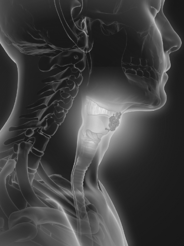When is Thyroid Cancer NOT a Cancer?