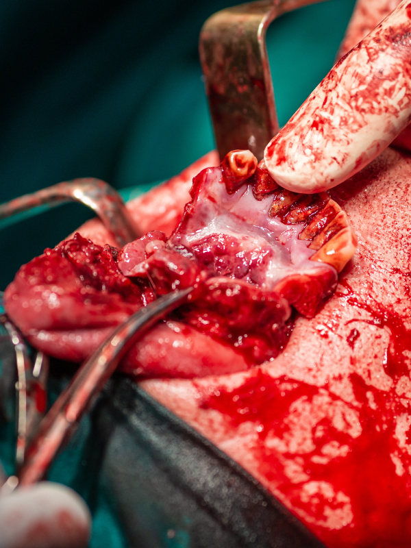 Burden Of Oral Cancer In India