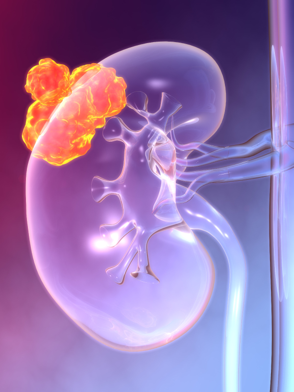 Advancements In The Diagnosis & Management Of Kidney Cancer