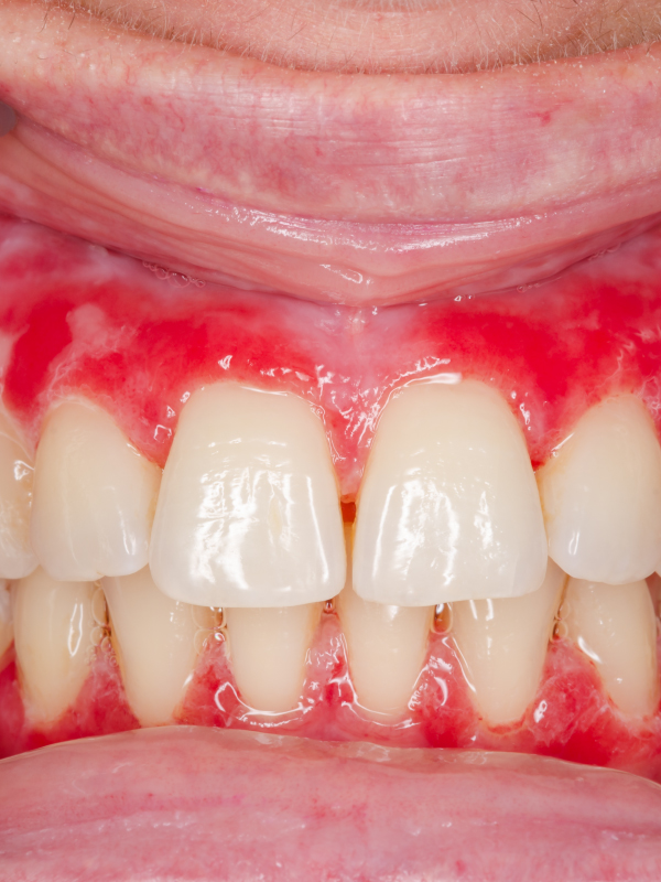Sjögren's Syndrome – Oral Manifestations and Management