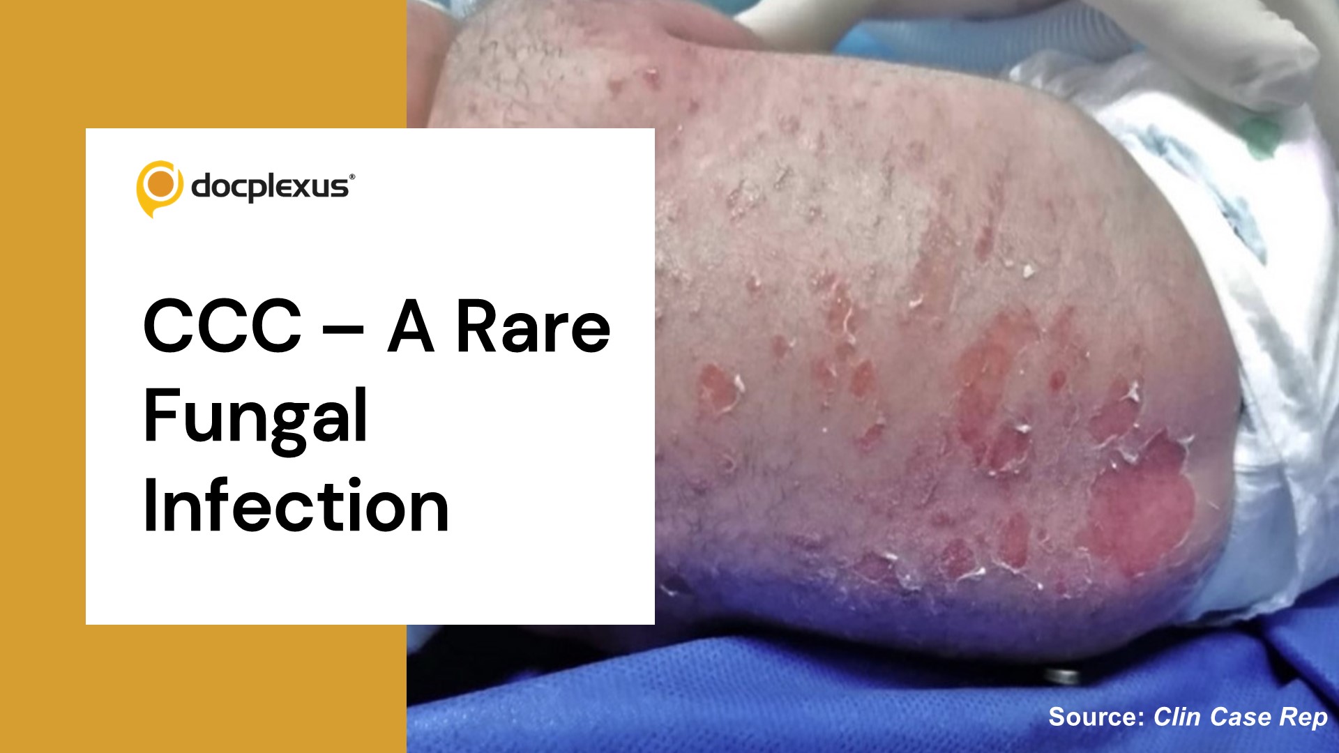 Congenital Cutaneous Candidiasis in a Premature Neonate