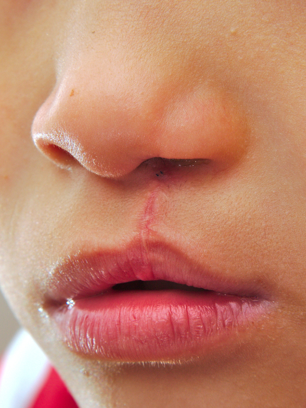 Unilateral Cleft Lip Repair – Assessment, Planning, and Techniques